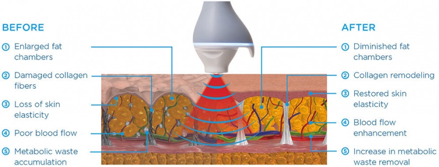 Best cellulite treatment in Dubai; BTL Unison Best cellulite treatment in Dubai; BTL Unison
